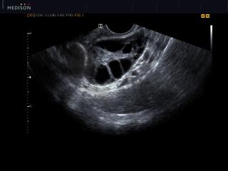 Ovary with follicles, B-mode