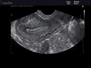 Endometrium, B-mode