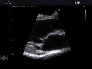 Heart (long axis of LV), B-mode