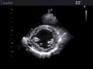 Heart (short axis of LV), B-mode