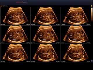 Fetal brain, MSV & 3D