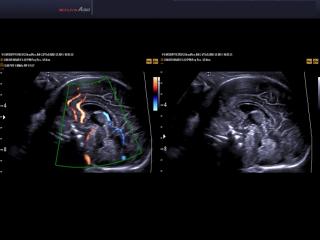 Fetal brain, DPDI & DMR