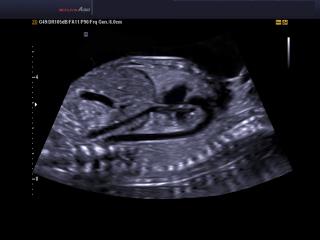 Fetal heart aortic arch, THI & DMR