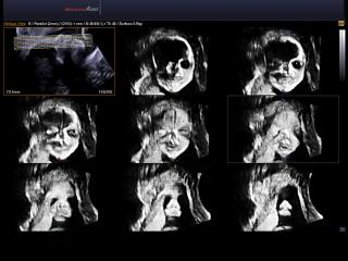 Fetal face, Multi OVIX & 3D