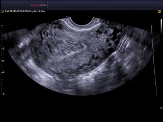 Uterus adenomyosis, B-mode & SRF