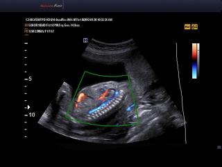 Fetus, Color OptFlow, THI & DMR