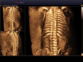Fetal spine, 3D