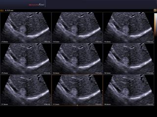 Liver - hemangioma, MSV