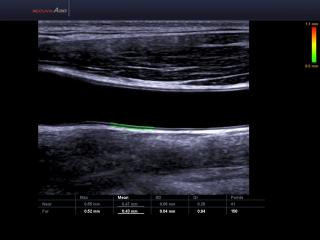 Common carotid artery, Auto IMT