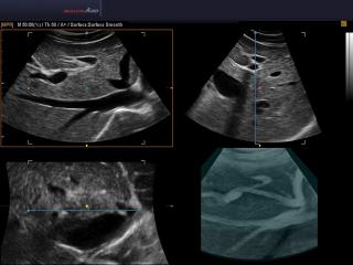 Liver, 3D inversion