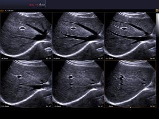 Liver, MSV & HDVI