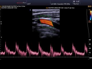 Common carotid artery, CFM & PW