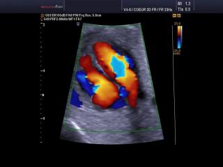 Fetal heart, color doppler