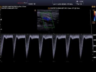 Popliteal artery, CFM & PW