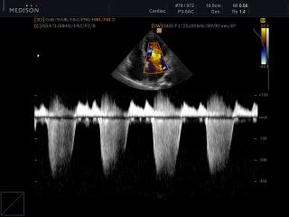 Mitral valve - regurgitation, CFM & CW