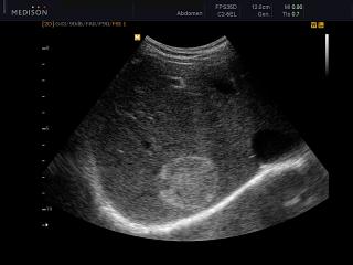 Liver - hemangioma, B-mode