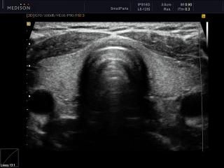 Thyroid, B-mode