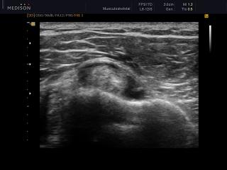 Rupture and hematoma of biceps tendon, B-mode