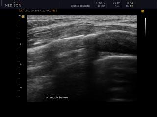 Fracture of 5-th rib, B-mode