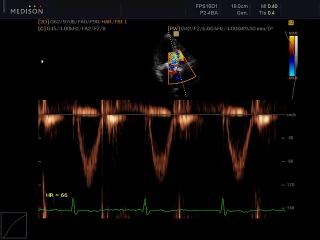 Aortic valve, CFM & PW