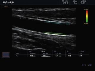 Common carotid artery, AutoIMT