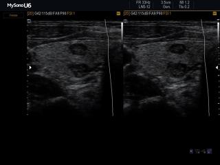 Thyroid mass, B-mode