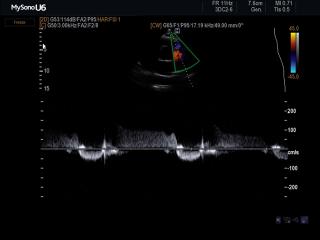 Pulmonary regurgitation, CFM & CW