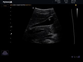 Gall bladder - polyp, В-mode