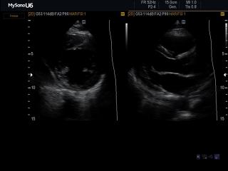 Heart (short & long axis of the LV), B-mode