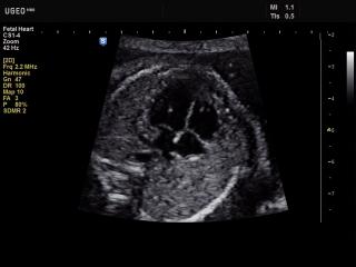 Fetal heart, B-mode