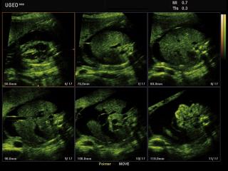 Fetal abdomen ascites, MSV