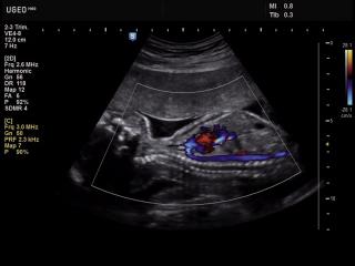 Fetus - aorta, CFM