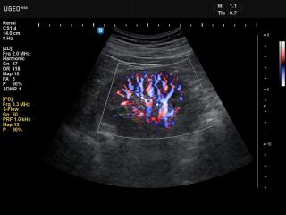 Renal vessels, S-flow