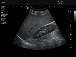 Kidney, B-mode