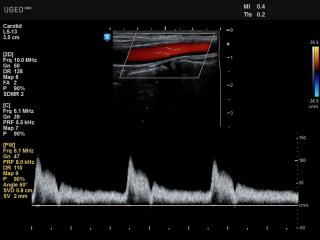 Common carotid artery, CFM & PW