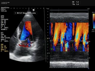 Heart, color M-mode