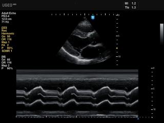 Heart, M-mode