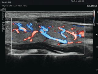 Thyroid, S-Flow