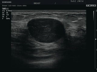 Breast - nodule, Clear Vision