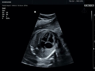 Fetal heart, ClearVision
