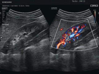 Kidney in S-Flow