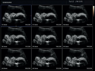 Fetal head, MSV