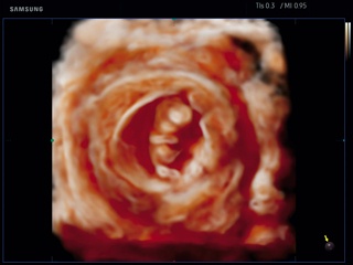 Fetus - 1-st trimester, Realistic Vue 3D