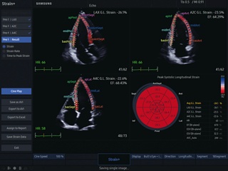 Heart, Strain+