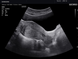 Uterus, S-Harmonic