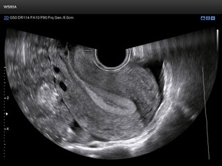 Uterus, B-mode