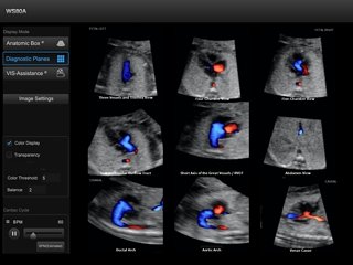 Fetal heart, 5D Heart Color