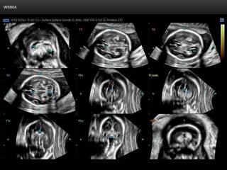 Fetal brain, 5D CNS