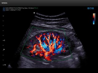 Renal flow, S-Flow