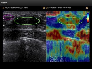 Breast, elastography